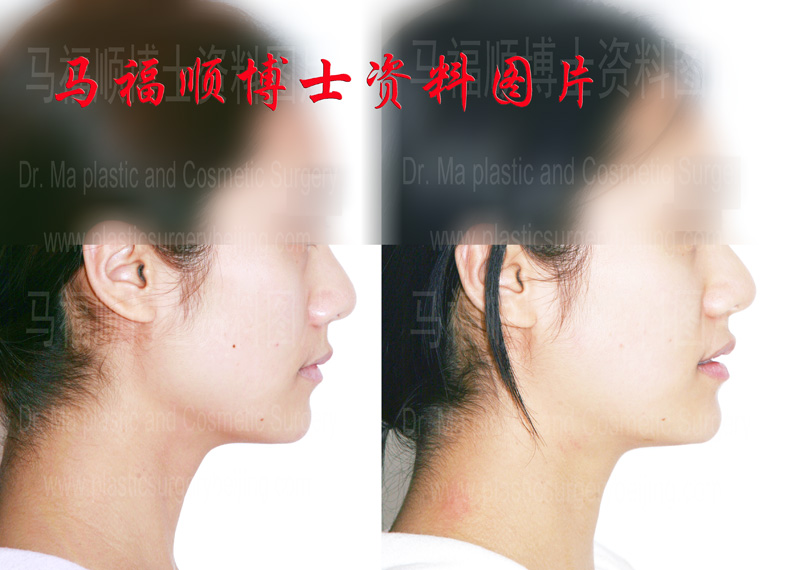 咬肌切除瘦脸侧面照片 咬肌切除瘦脸侧面照片