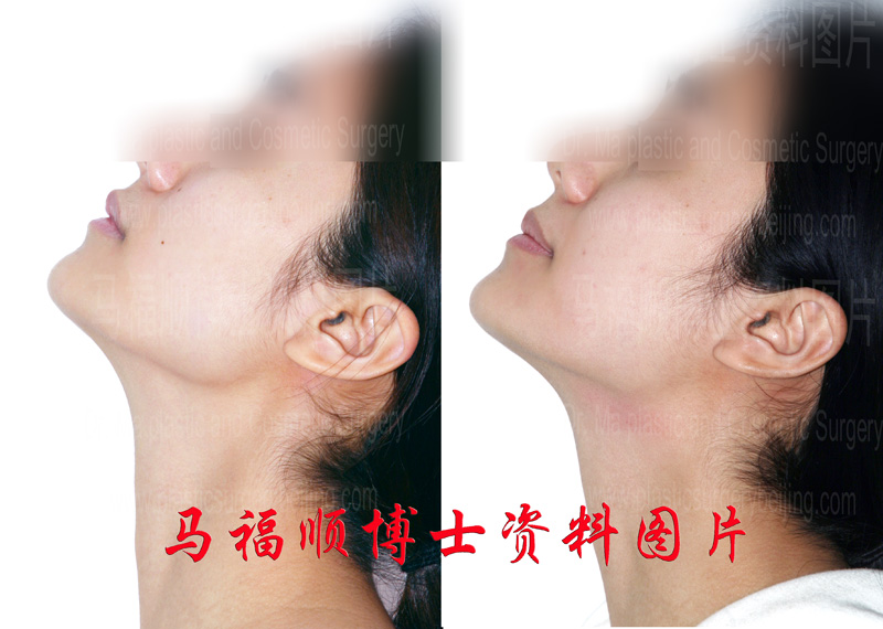 咬肌部分切除后仰头位照片 咬肌部分切除后仰头位照片