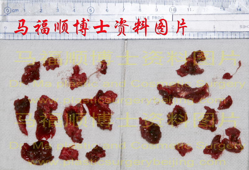 咬肌部分切除瘦脸时所切除的咬肌 咬肌部分切除瘦脸时所切除的咬肌