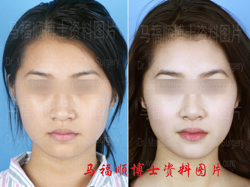 鼻骨缩窄术前及术后 鼻骨缩窄术前及术后