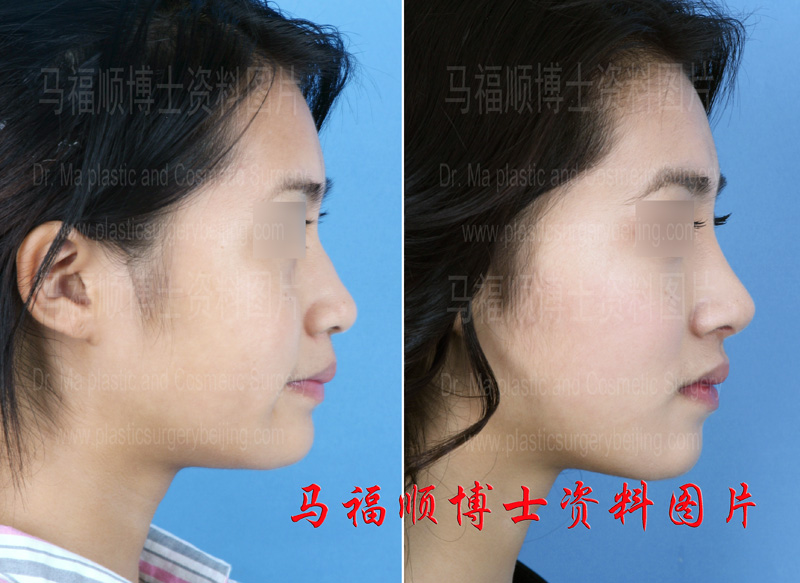 鼻骨缩窄手术前后侧面 鼻骨缩窄手术前后侧面
