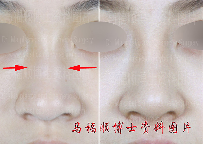 宽鼻缩窄术 宽鼻缩窄术