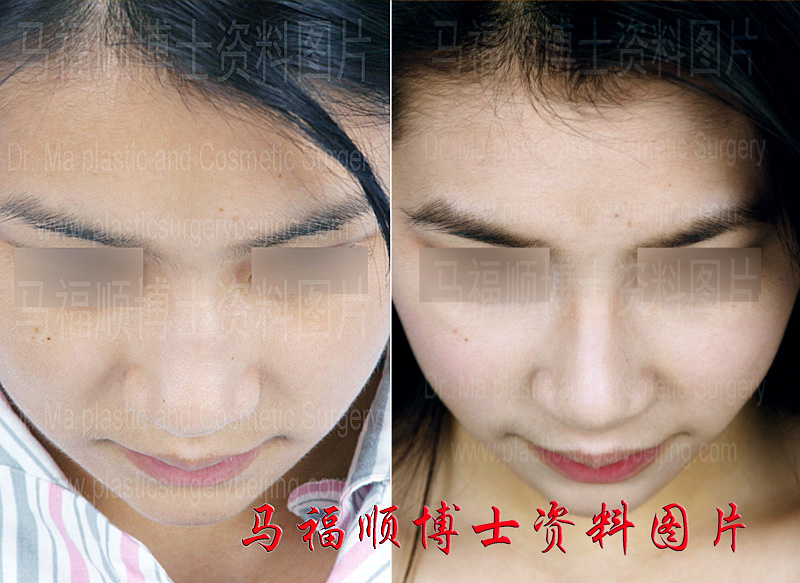 宽鼻鼻骨缩窄手术前后低头位 宽鼻鼻骨缩窄手术前后低头位