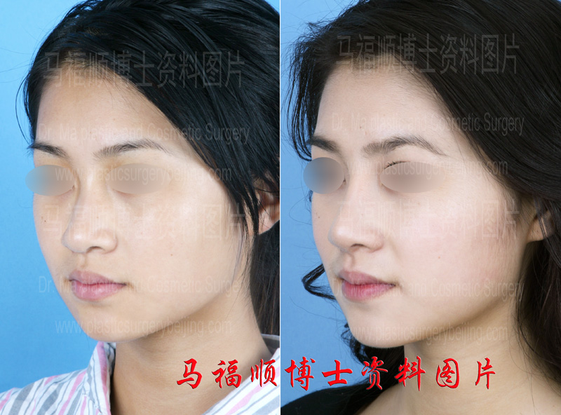 鼻骨缩窄后斜位照片 鼻骨缩窄后斜位照片