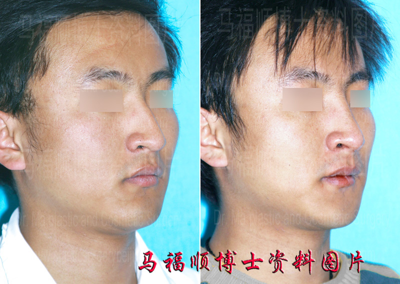 歪鼻矫正术对比照片