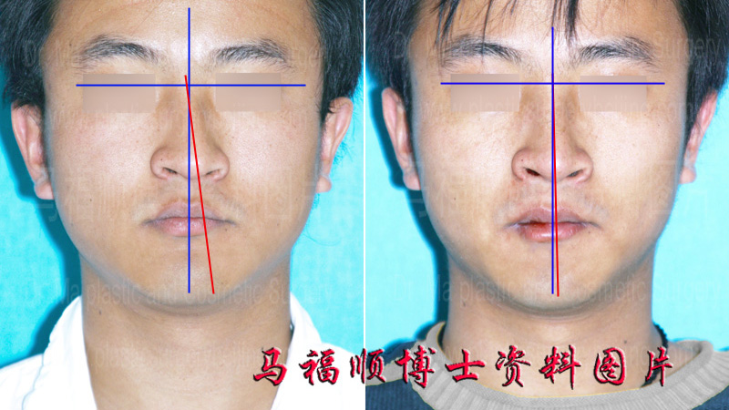 歪鼻整形前后分析