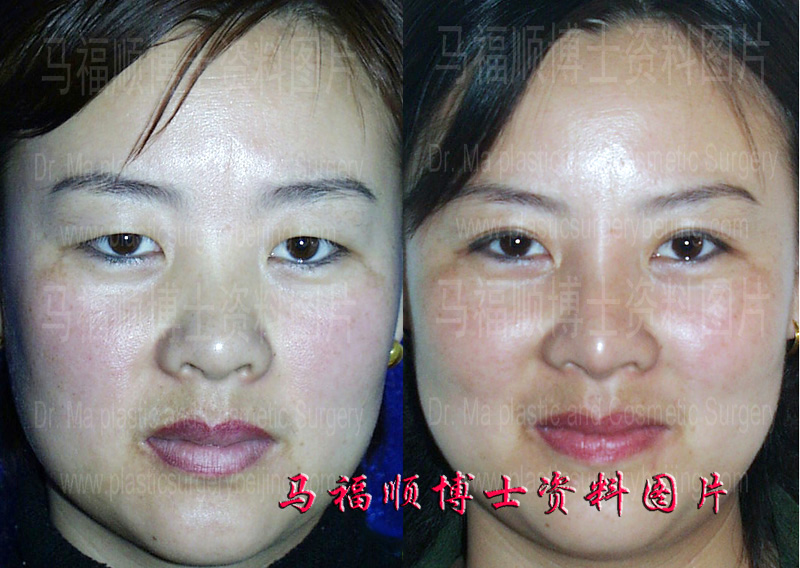 假体隆鼻对比照片