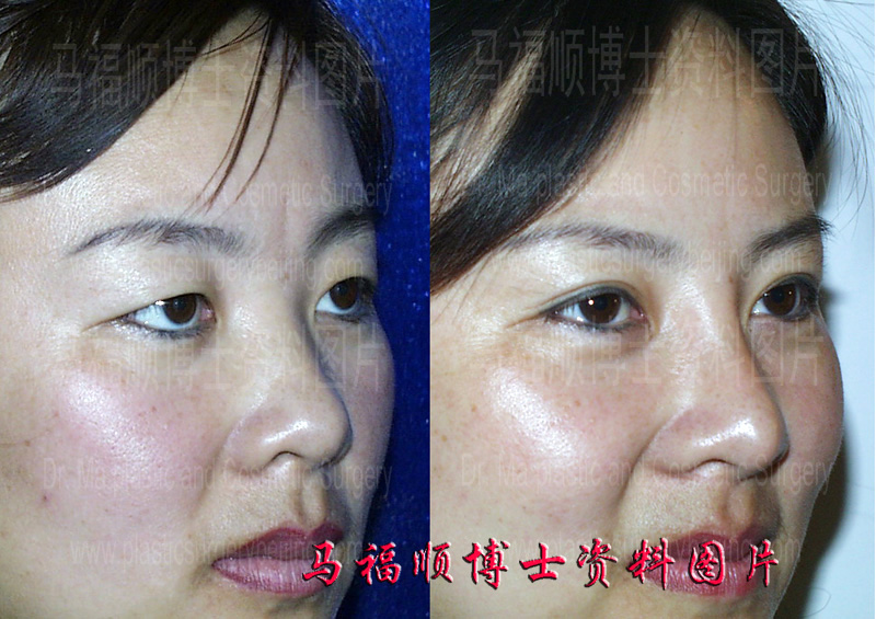 硅胶假体隆鼻术前术后