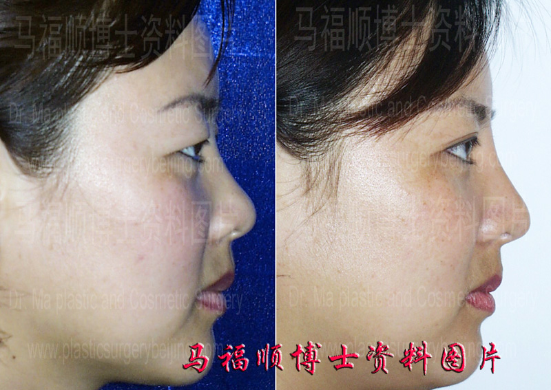 假体隆鼻及重睑整形