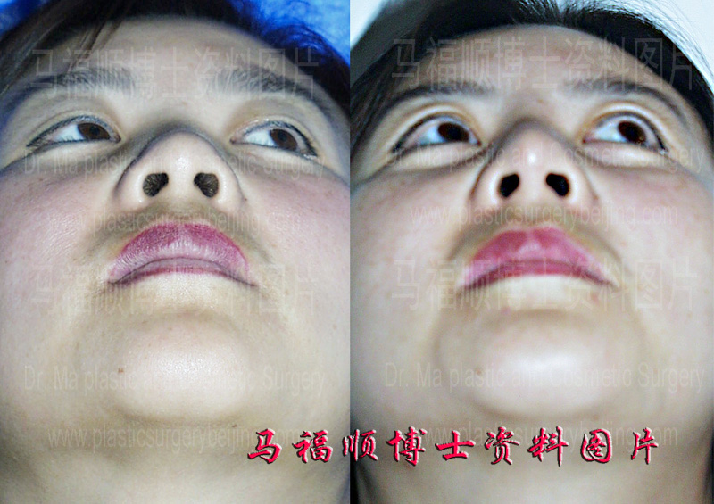 硅胶假体隆鼻仰头位对比照片