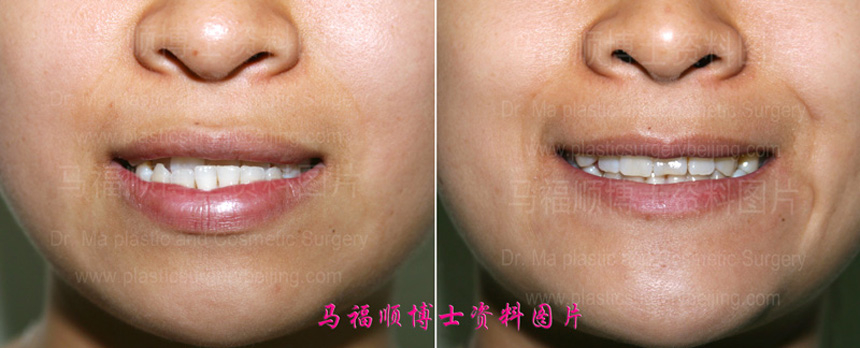 小反颌畸形牙齿对比