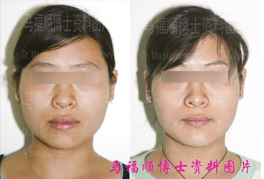 反颌畸形术前术后对比