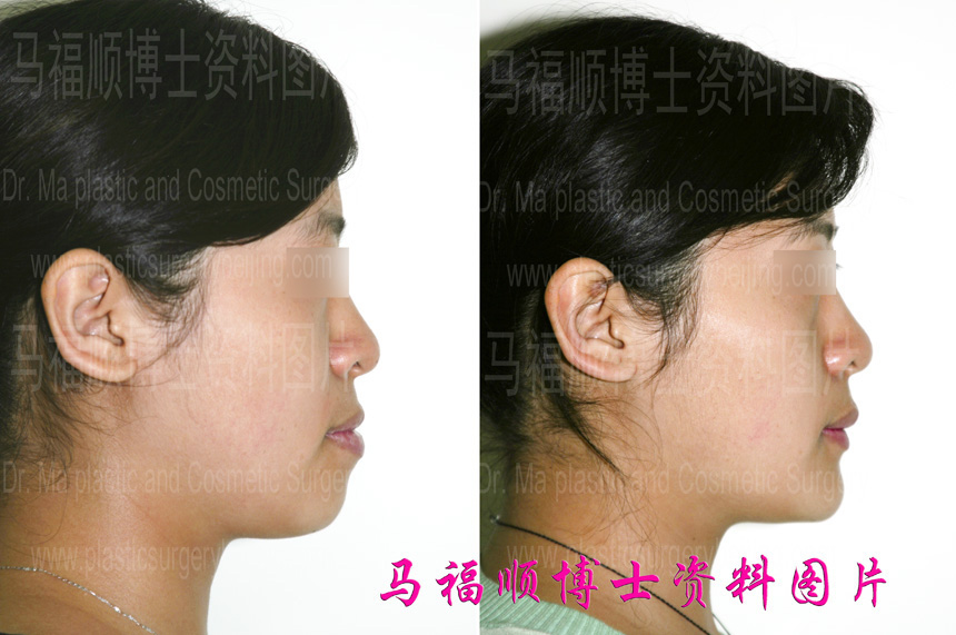 小反颌畸形整形对比