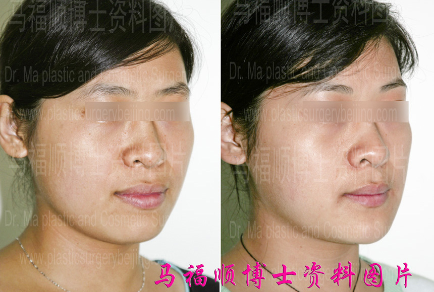 小反颌整形斜位