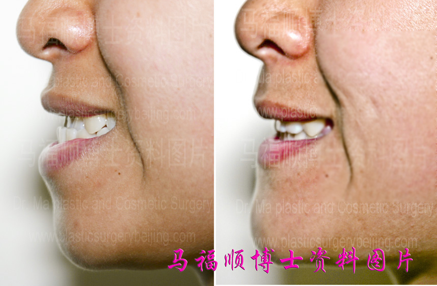 小反颌畸形整形