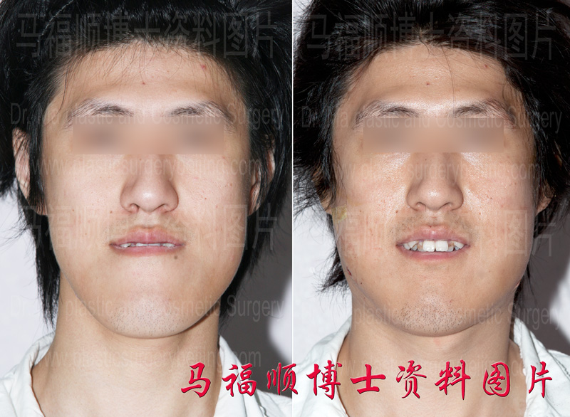 兜齿整形手术前后照片