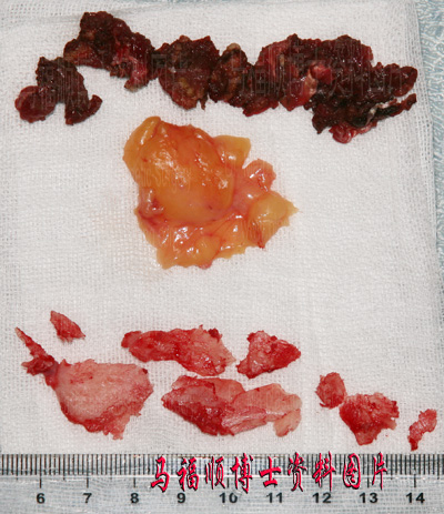 大小脸整形所切下的组织