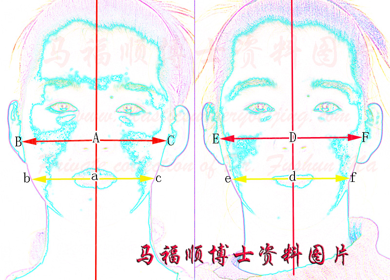 偏脸整形术前术后分析