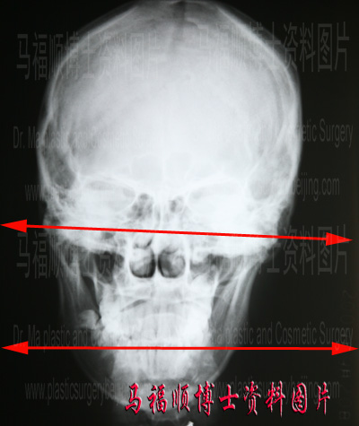 面部不对称者X线照片