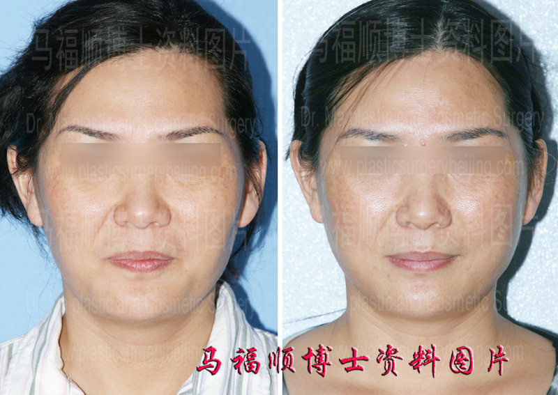 颧骨降低整形术