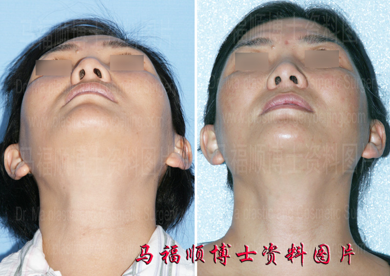 颧骨降低仰头位