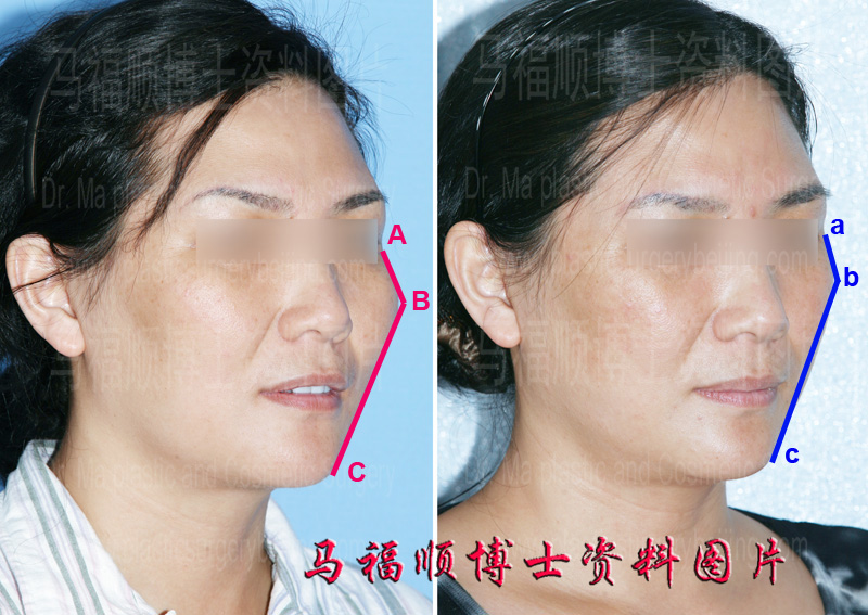 颧骨整形后颧突点的变化