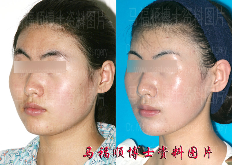 大脸变小脸斜位照片
