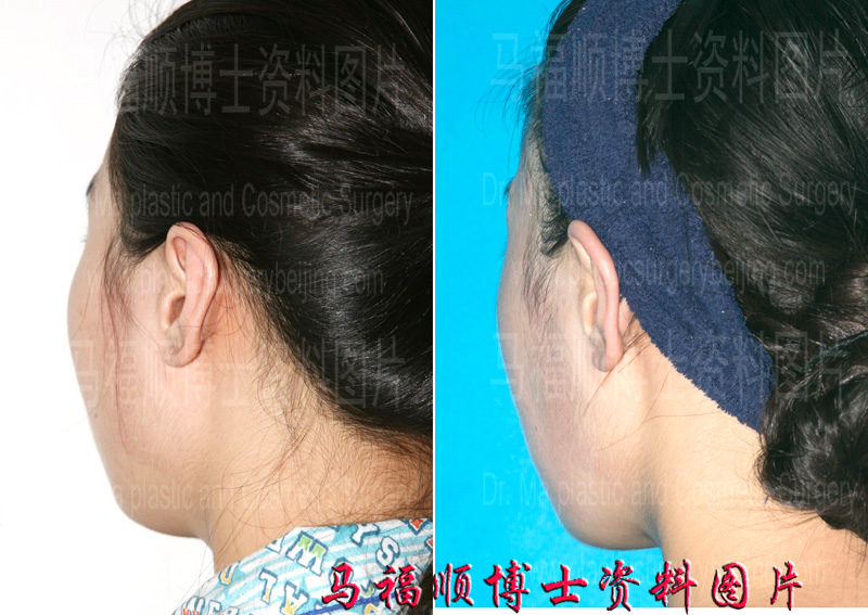 大脸变小后颧骨的突出度变小