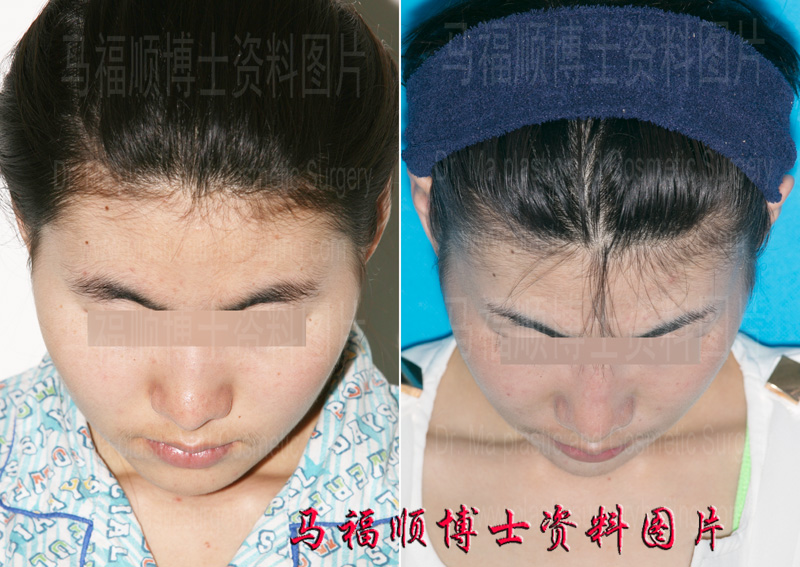 颧骨颧弓缩小的效果