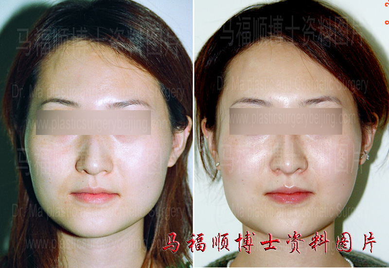不对称颧骨颧弓整形