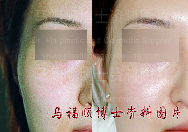 颧骨颧弓整形后右侧面部改变