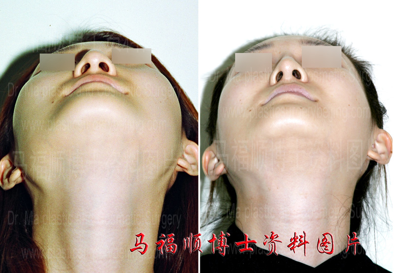 不对称颧骨颧弓整形后仰头位