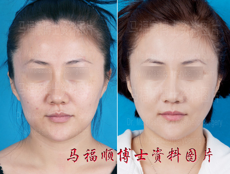 颧骨颧弓下颌骨整形后更年青