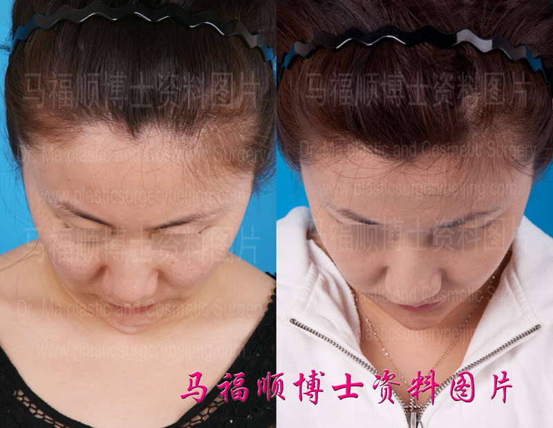 颧骨颧弓下颌角整形后面部皮肤紧致