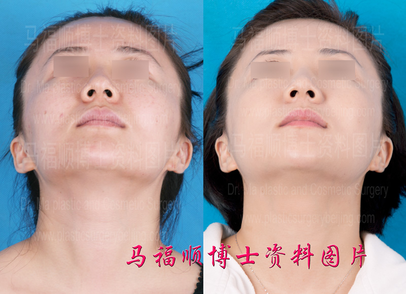 颧骨颧弓下颌骨整形后仰头位