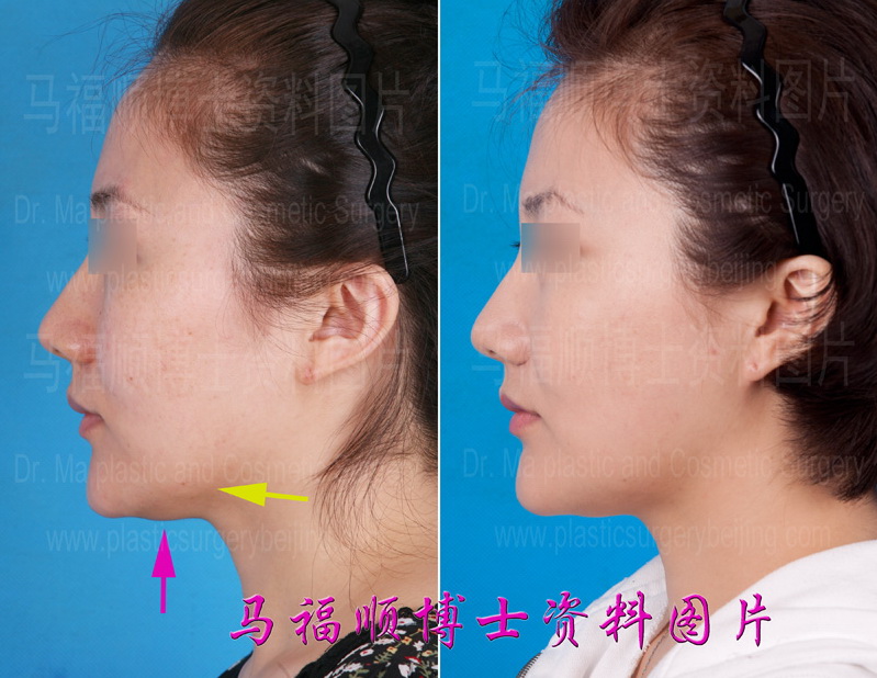 面部骨骼缩小整形后皮肤上提