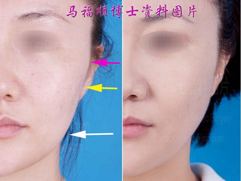 颧骨颧弓下颌骨整形后侧面部轮廓线的变化