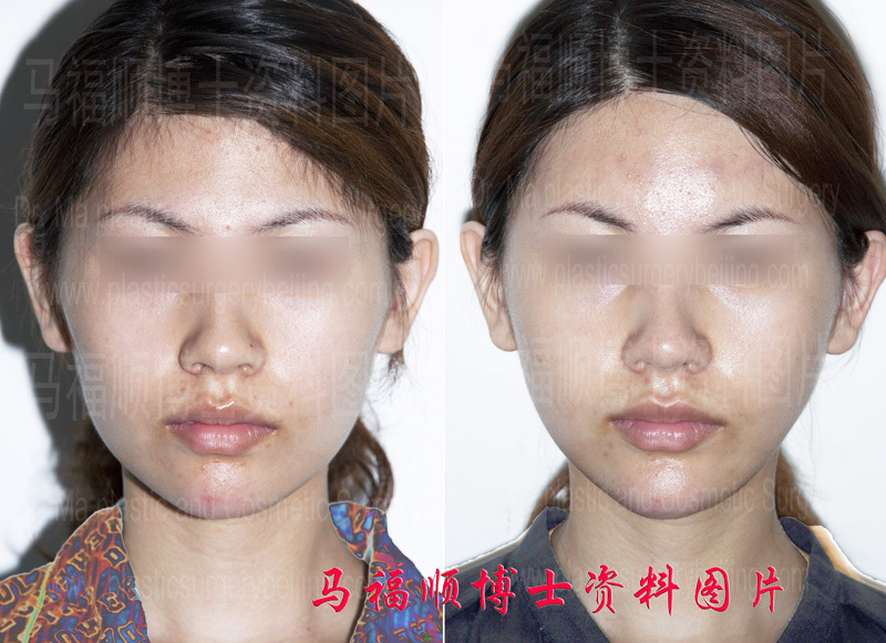颧弓颧骨舒平术对比照片