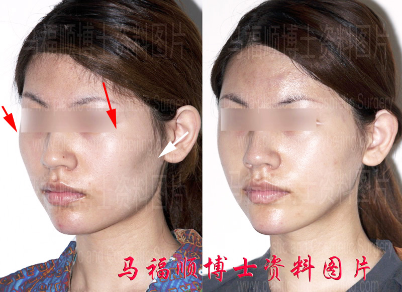 颧弓颧弓舒平术对比照片左侧斜位