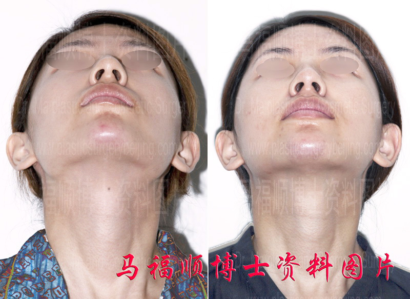 颧弓颧骨舒平术对比照片仰头位