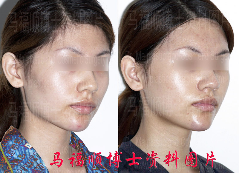 颧弓颧骨舒平对比照片右侧斜位