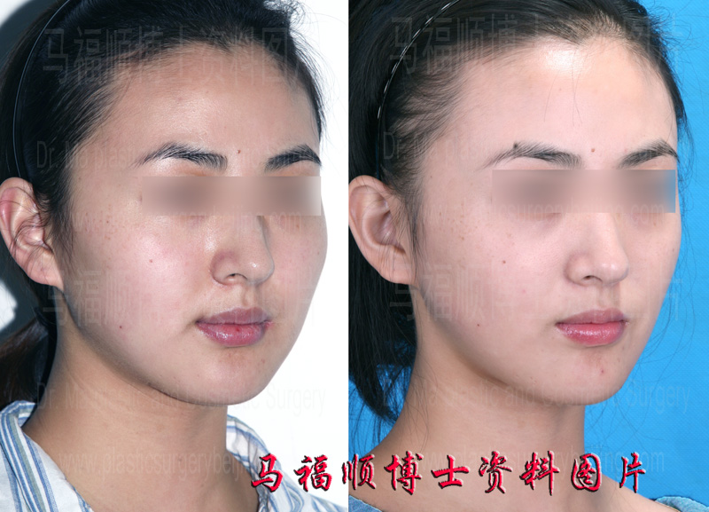 颧骨颧弓整形后脸变小