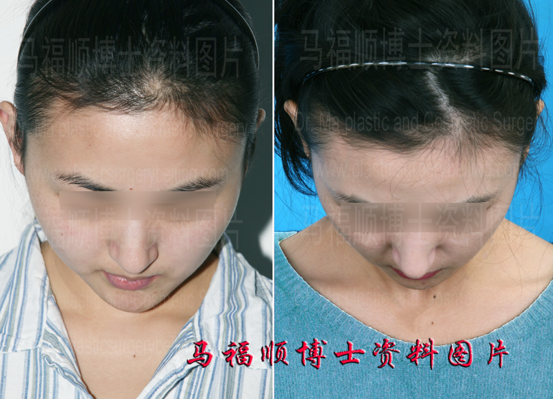 颧骨颧弓缩小整形后低头位