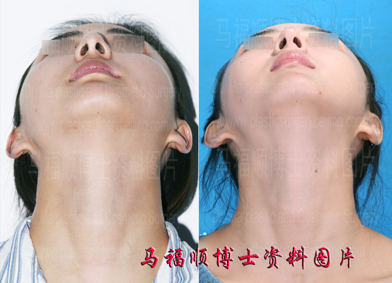 颧骨颧弓缩小整形仰头位