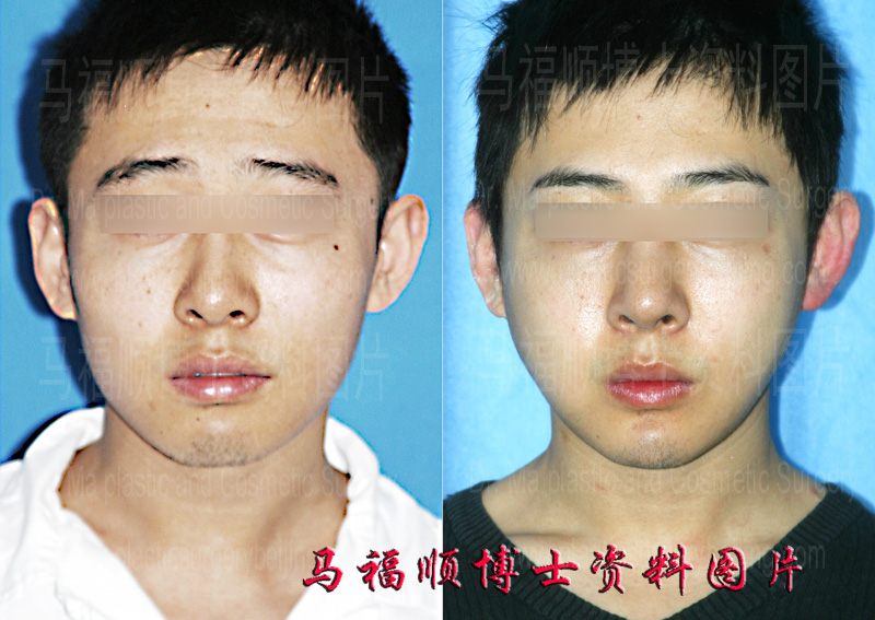 颧骨颧弓下颌骨缩小整形