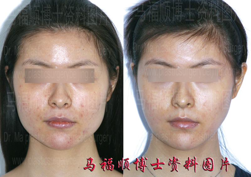 瘦脸整形