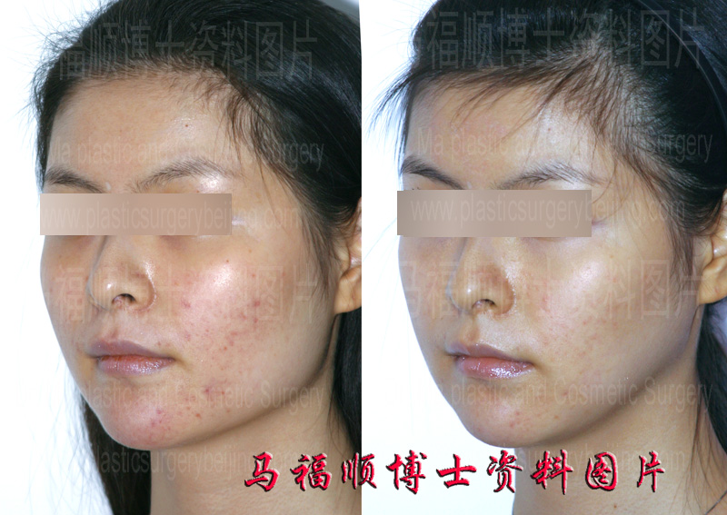 颧骨颧弓降低瘦脸