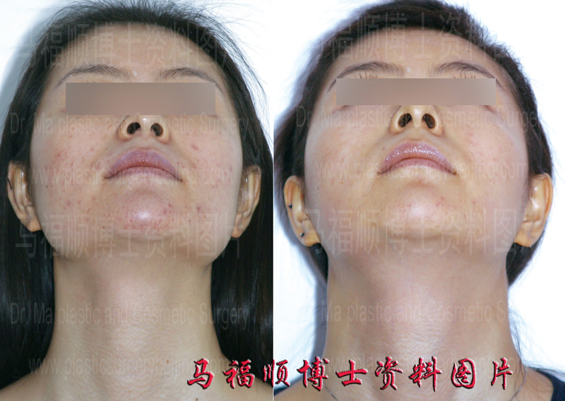 颧骨下颌骨整形仰头位