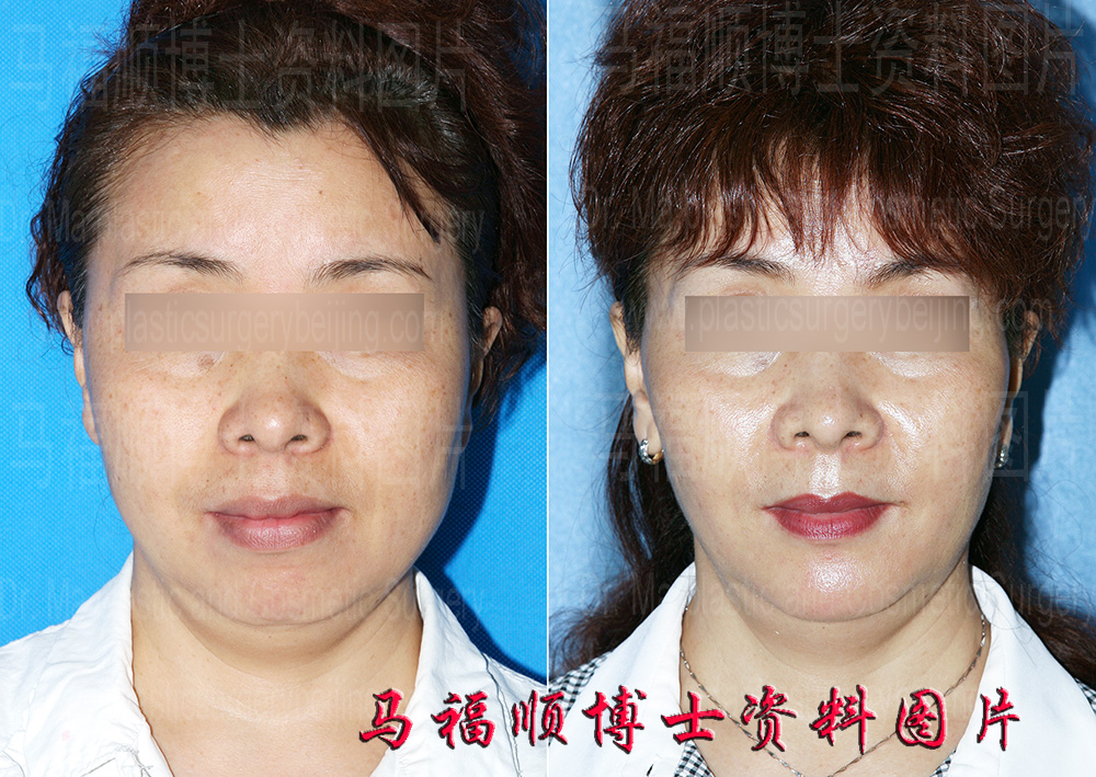 上下颌前突整形正面