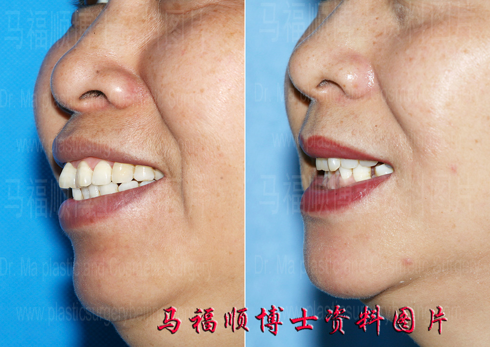 上下颌前突整形后的笑容